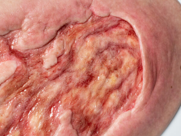Stick-On Large Ulcer mit Unterminierung – Bild 5