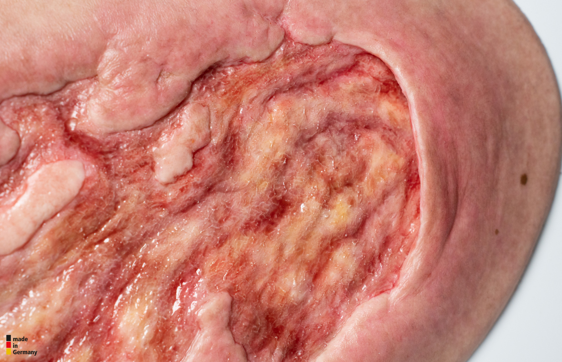 Stick-On Large Ulcer mit Unterminierung – Bild 5