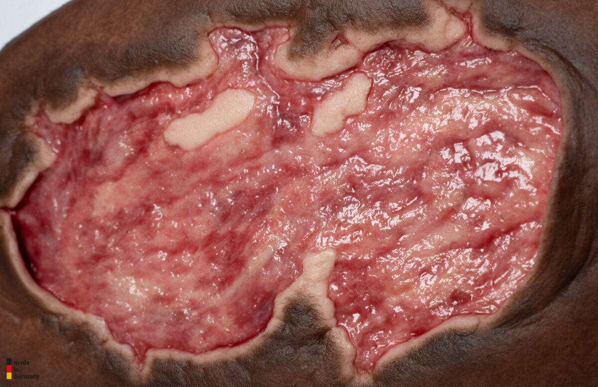 Stick-On Large Ulcer mit Unterminierung