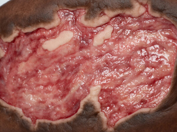 Stick-On Large Ulcer mit Unterminierung – Bild 7