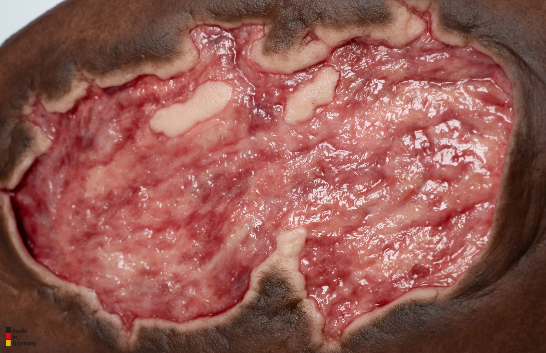 Stick-On Large Ulcer mit Unterminierung – Bild 7