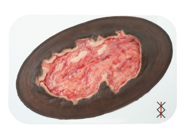 Stick-On Large Ulcer mit Unterminierung – Bild 13