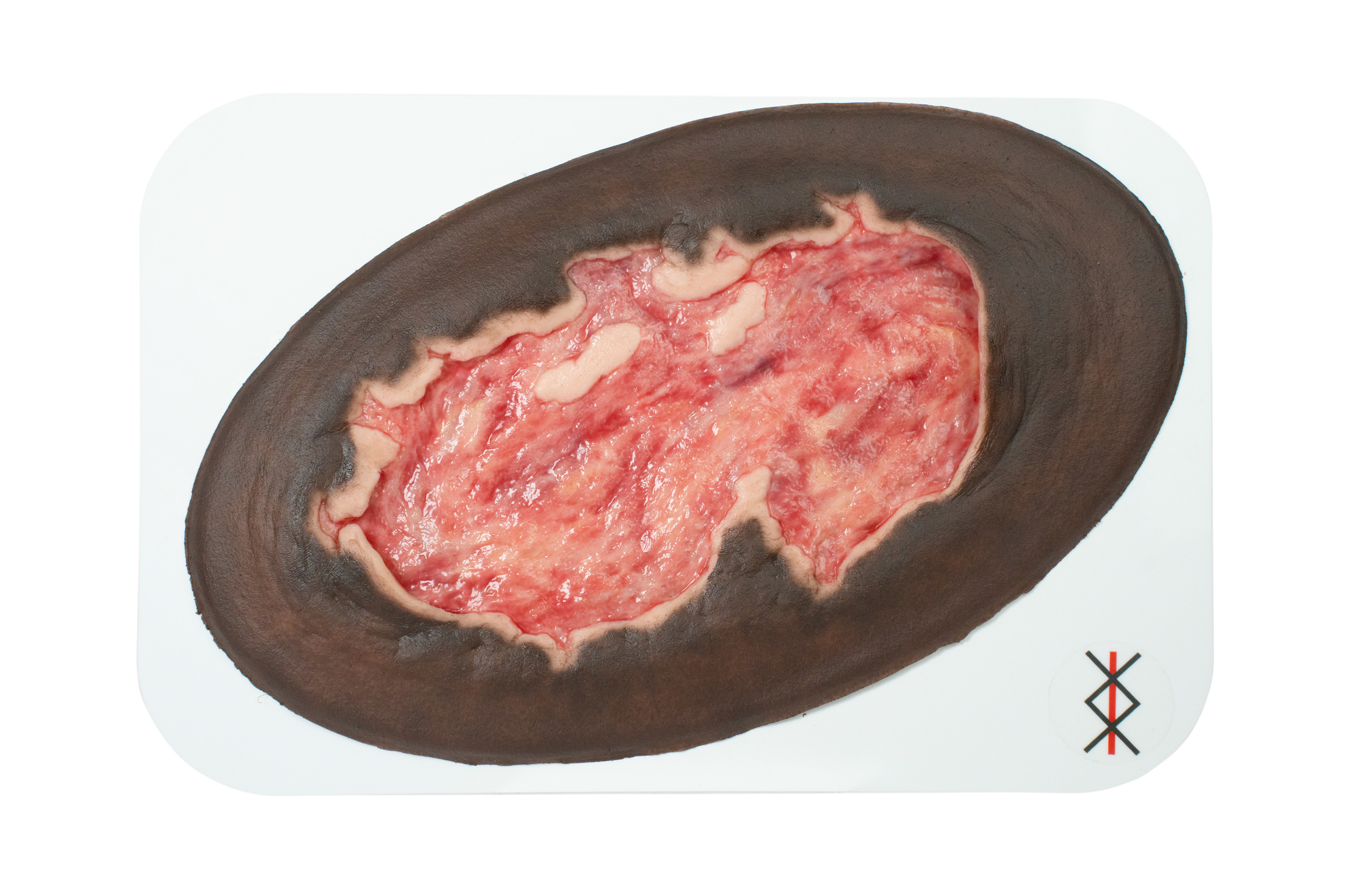 Stick-On Large Ulcer mit Unterminierung – Bild 13