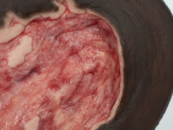 Stick-On Large Ulcer mit Unterminierung – Bild 8