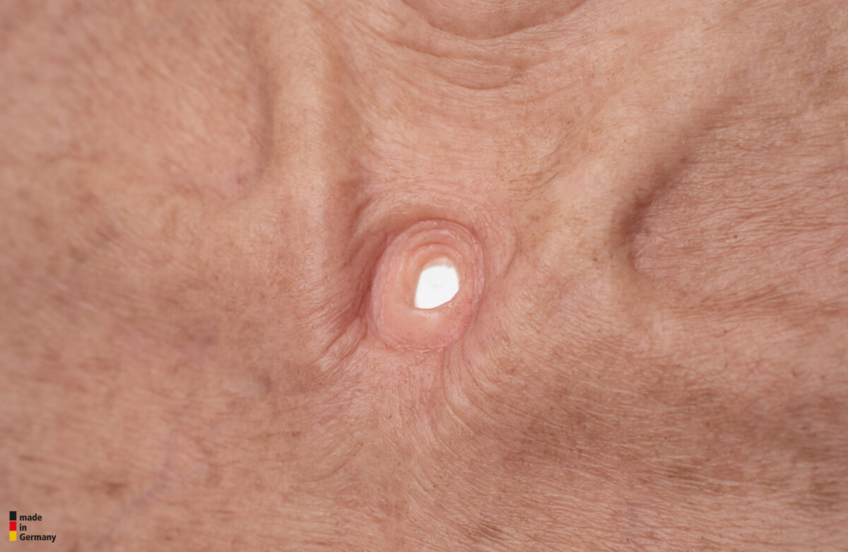 Stick-On Large Tracheostoma (Luftröhrenschnitt)
