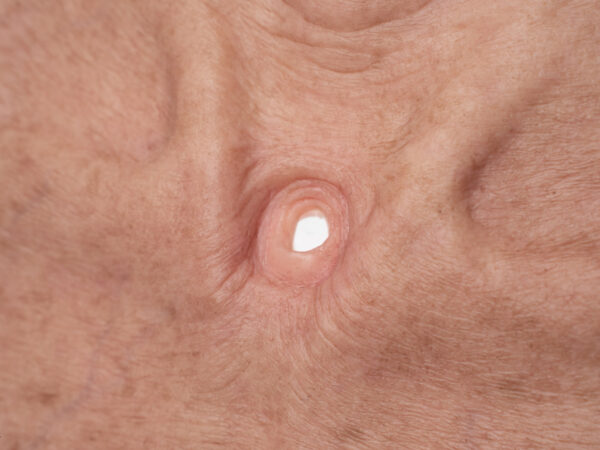 Stick-On Large Tracheostoma (Luftröhrenschnitt) – Bild 2