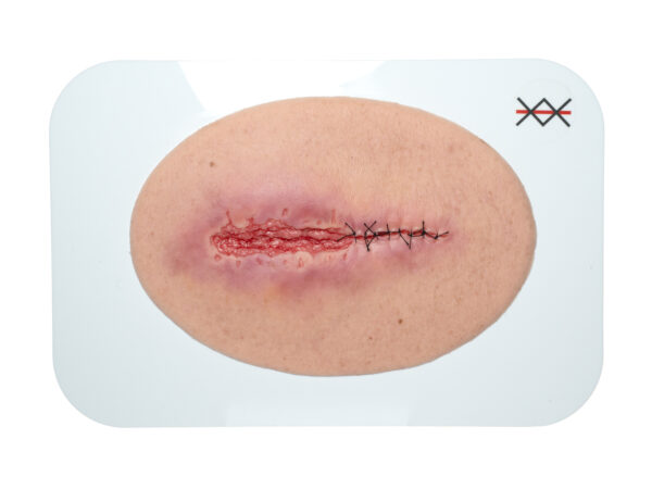 Stick-On Medium Surgical Wound Opened