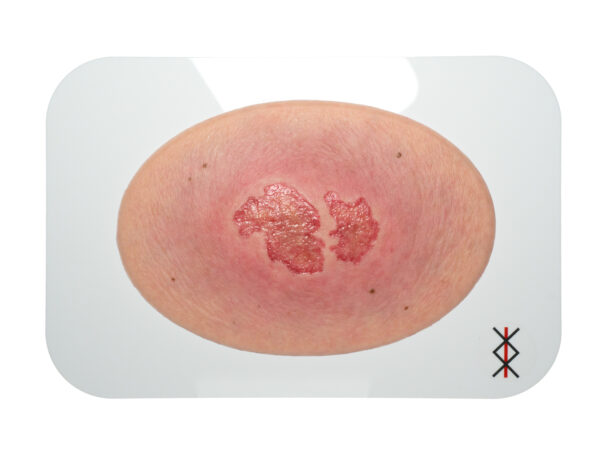 Stick-On Medium Pressure Ulcer Stage 2