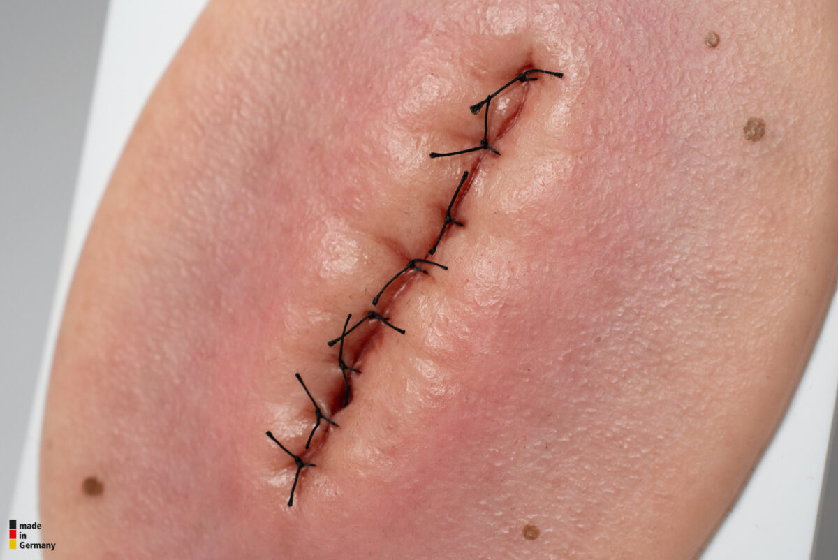 Stick-On Small OP-Wunde geschlossen und entzündet