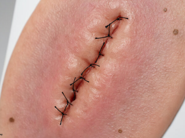 Stick-On Small OP-Wunde geschlossen und entzündet – Bild 2