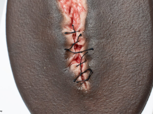 Stick-On Small OP-Wunde geöffnet – Bild 2