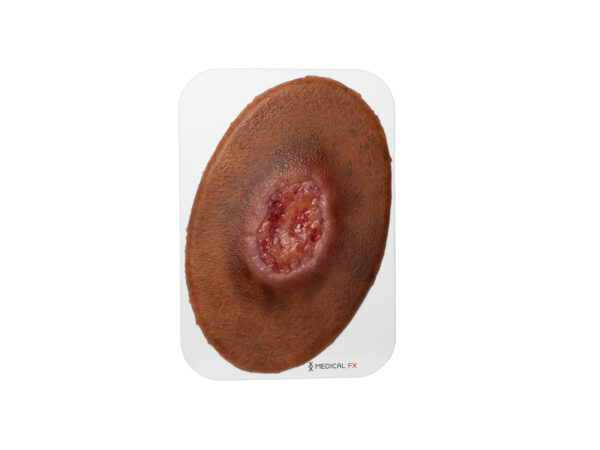 Stick-On Small Dekubitus Grad 3 – Bild 6