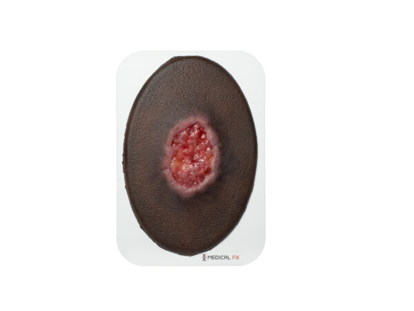 Stick-On Small Dekubitus Grad 3 – Bild 7