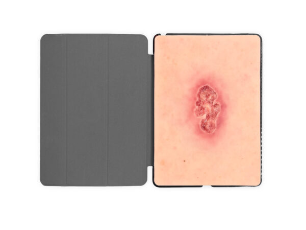 Tabletwunde Ulcer Chronische Wunde
