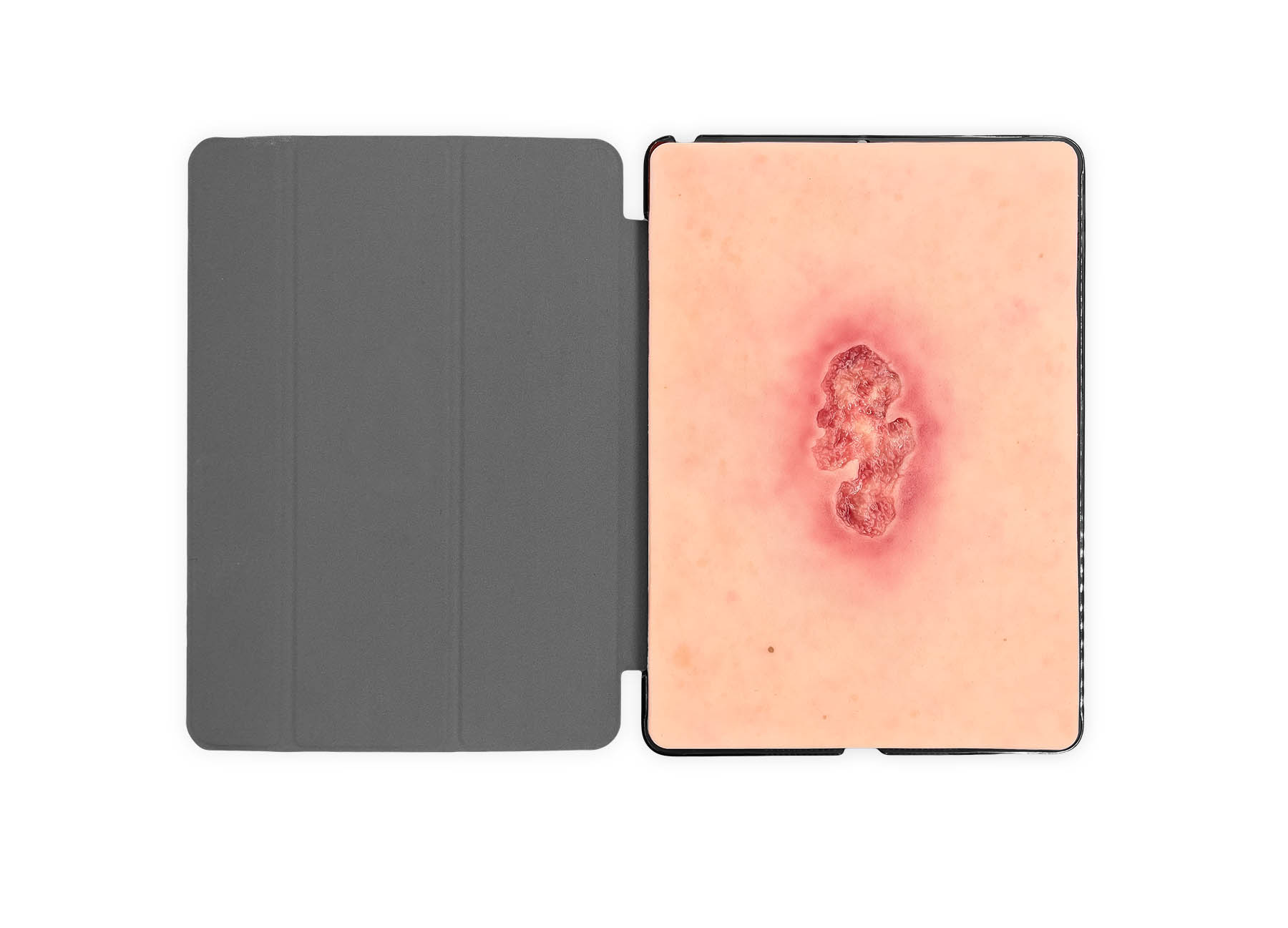 Tabletwunde Ulcer Chronische Wunde – Bild 1