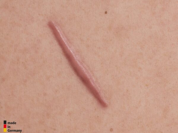Tabletwunde 4 Narbenmodell Keloide Narbe, Atrophe Narbe, Normale Narbe, Hypertrophe Narbe – Bild 6