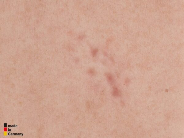 Tabletwunde 4 Narbenmodell Keloide Narbe, Atrophe Narbe, Normale Narbe, Hypertrophe Narbe – Bild 5