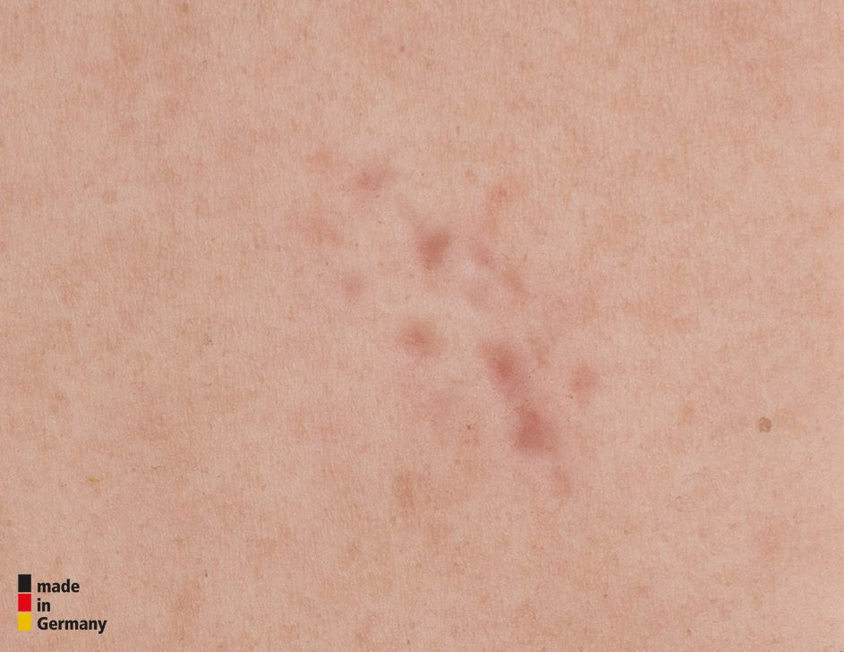 Tabletwunde 4 Narbenmodell Keloide Narbe, Atrophe Narbe, Normale Narbe, Hypertrophe Narbe