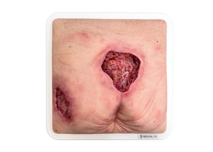FR11-08-0118-01-1-Frame-Model-Sacral-and-hip-pressure-ulcer-clean-wound-Aufsicht-LQ