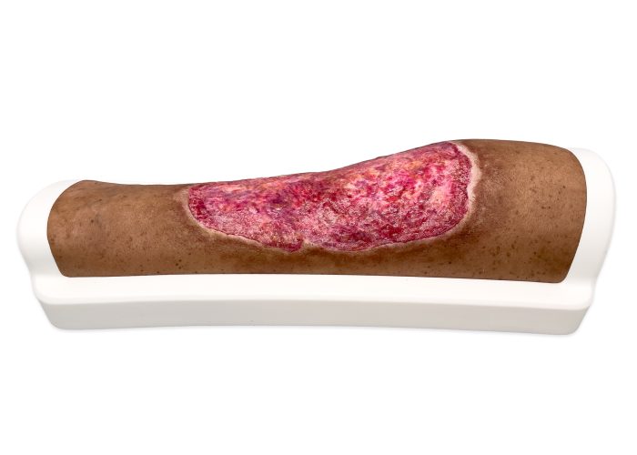 Rahmenmodell Venous Leg Ulcer (VLU)