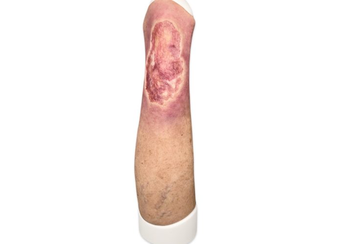 Sleeve Bein mit Ulcus Cruris-MEDICALFX-GERMANY-vorne-realistisch