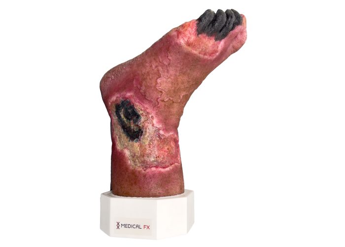 Sockelmodell Nekrotischer Fuß-medicalfx-realitisch