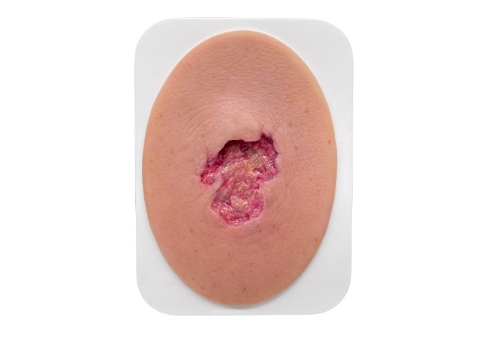 Stick-On Small Ulcer mit Unterminierung-medicalfx