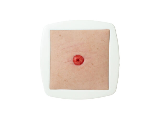 Frame Model Stoma at Skin Level